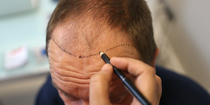 Haartransplantation ohne Rasur