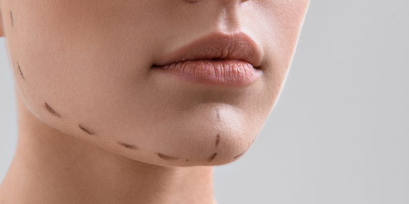 Chin Prosthesis