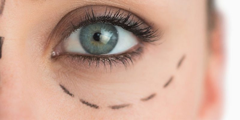 Eyelid Surgery