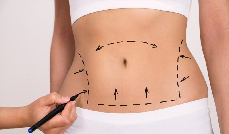 Tummy Tuck Surgery