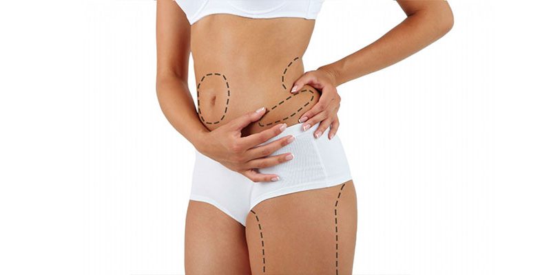 Liposuction